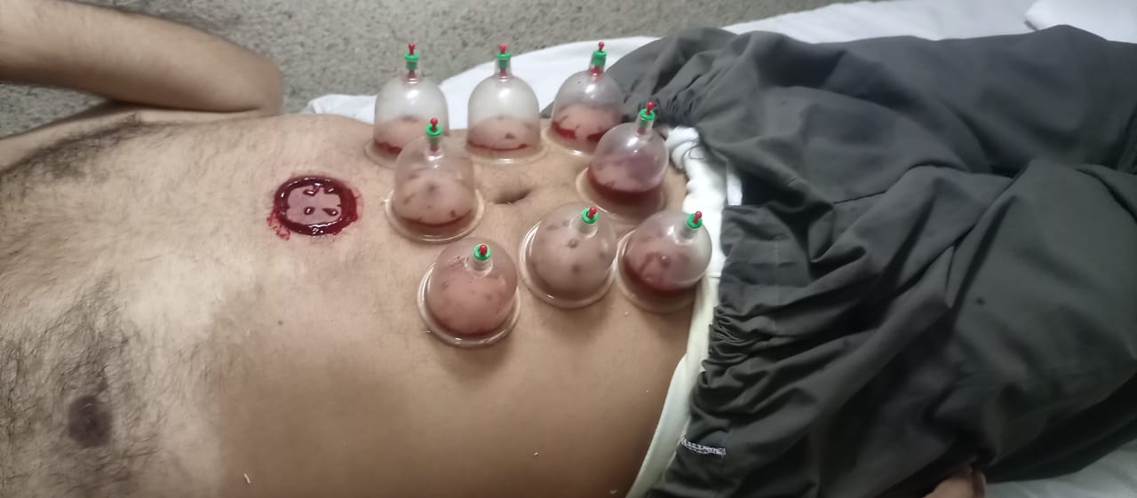 HIJAMA PER POINT