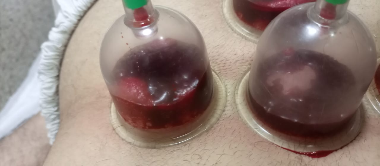 HIJAMA PER POINT