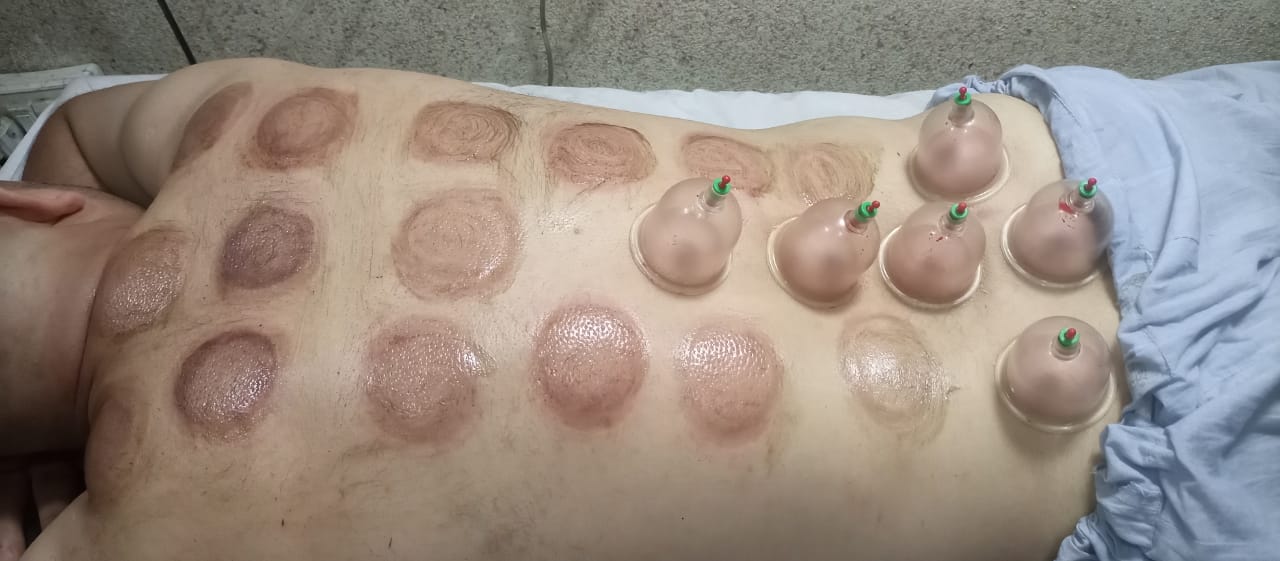 HIJAMA PER POINT